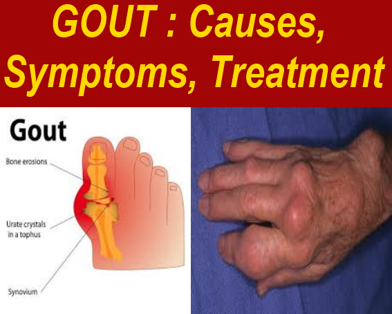 1 of th Best of: GOUT : Causes, Symptoms, Treatment