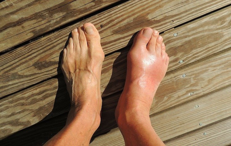 10 Home Remedies For Gout That Help Ease The Pain &  Swelling