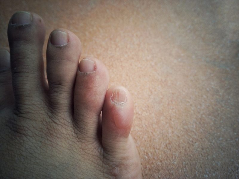 10 Signs of Disease Your Feet Can Reveal