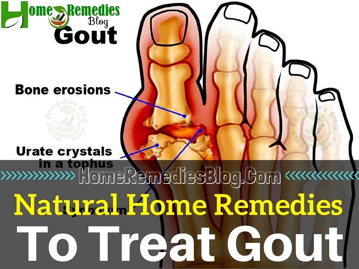 15 Proven Home Remedies for Gout With Diet Plan