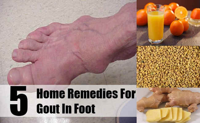 5 Home Remedies For Gout In Foot