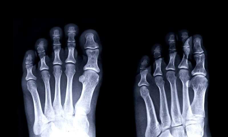5 Ways of Treating Gouty Arthritis
