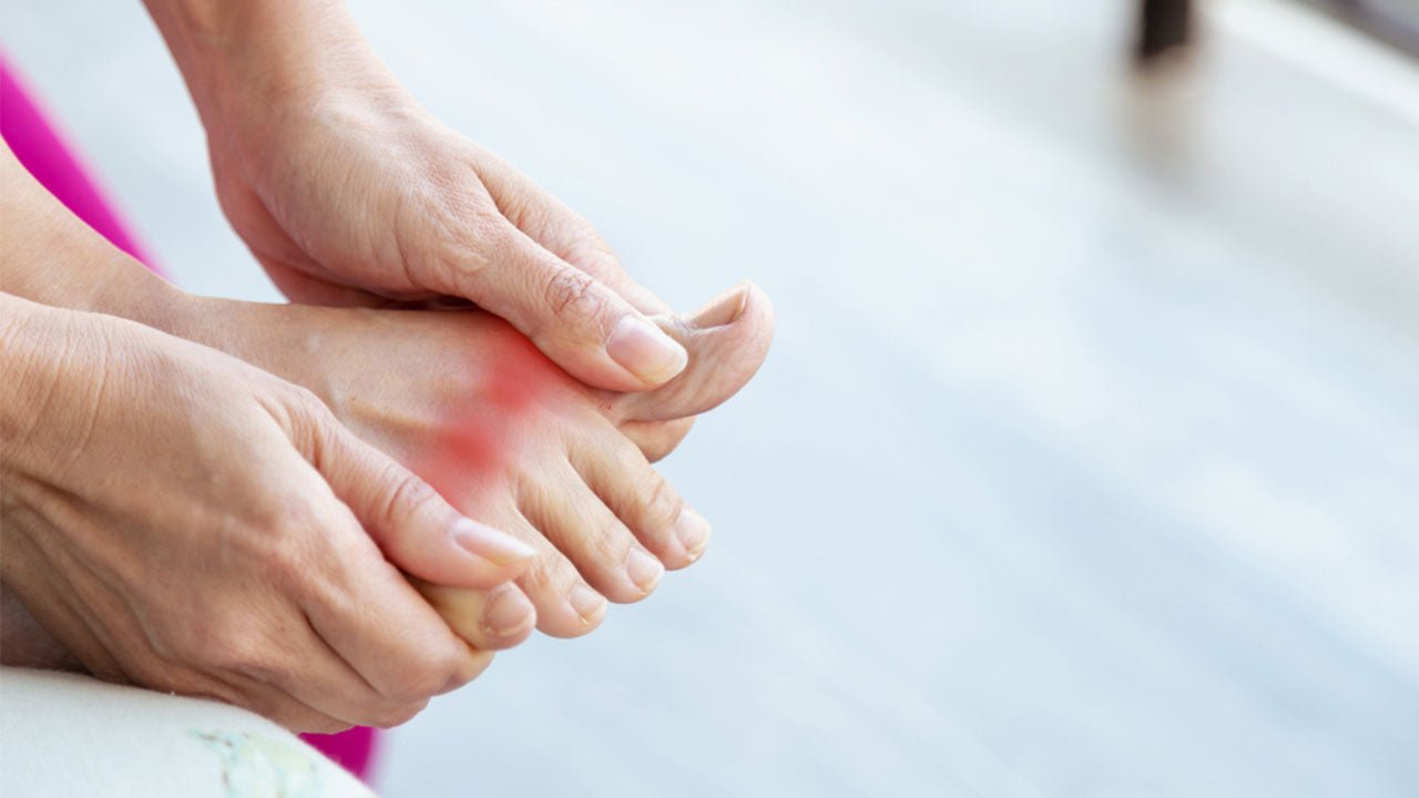 6 Natural Ways to Treat and Prevent Gout