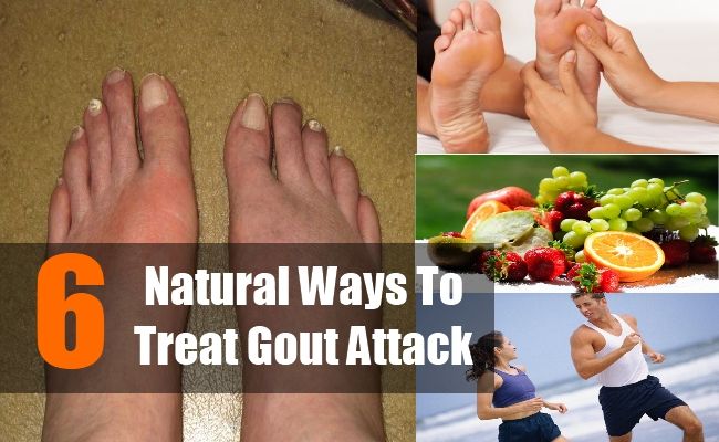 6 Natural Ways To Treat Gout Attack