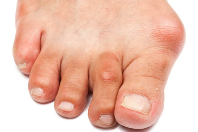 7 Risk Factors of Gout