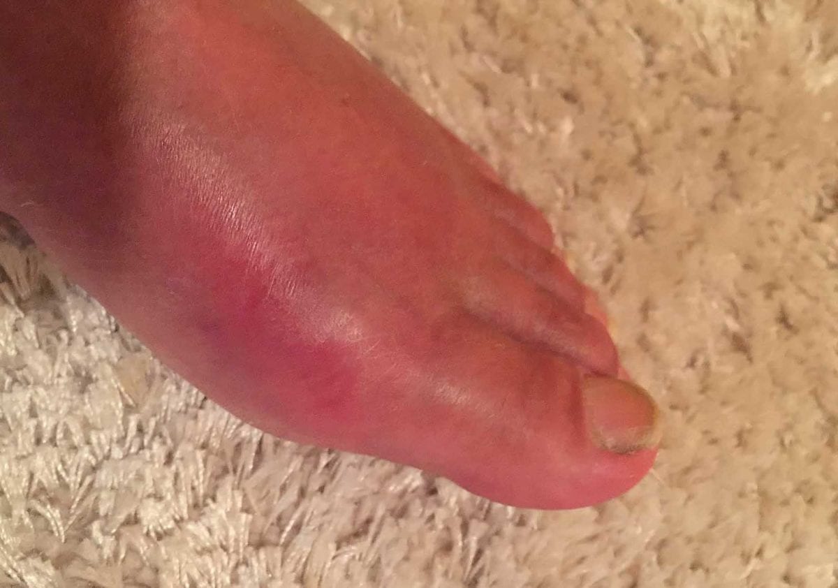 8 Medical Conditions That Can Cause Swollen Feet