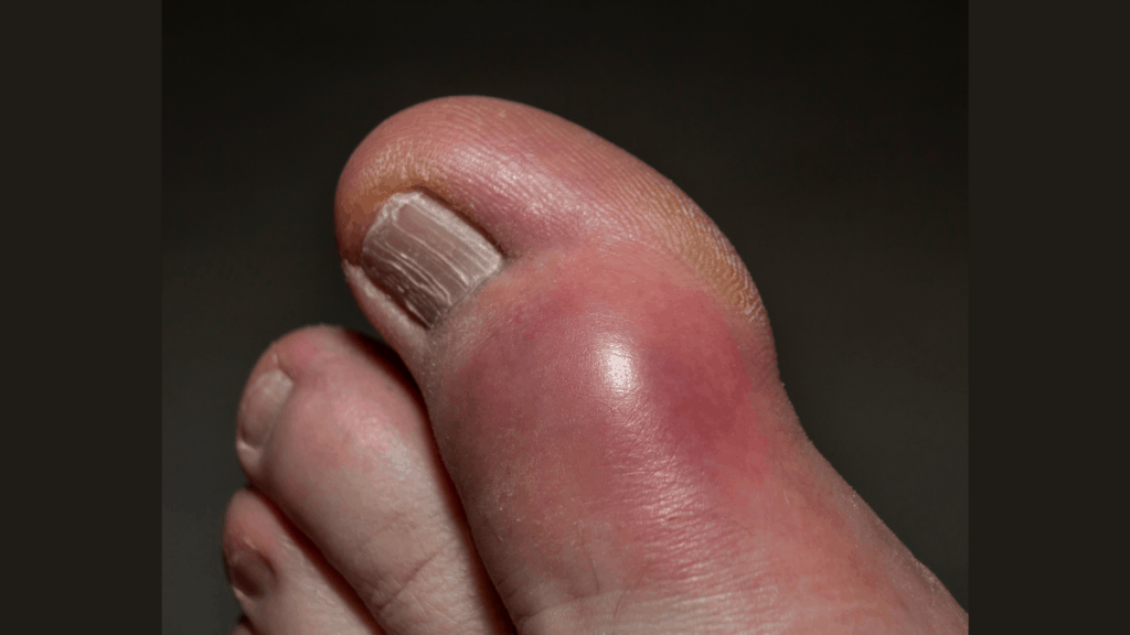9 Pictures of the Gout: Symptoms, Food to avoid, other tips : Physiosunit