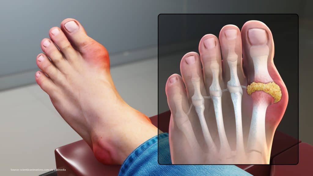 9 Pictures of the Gout: Symptoms, Food to avoid, other ...
