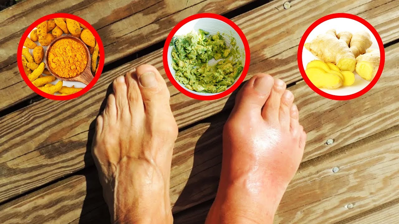 A Doctor Explains The Causes Of Gout And How To Treat It ...