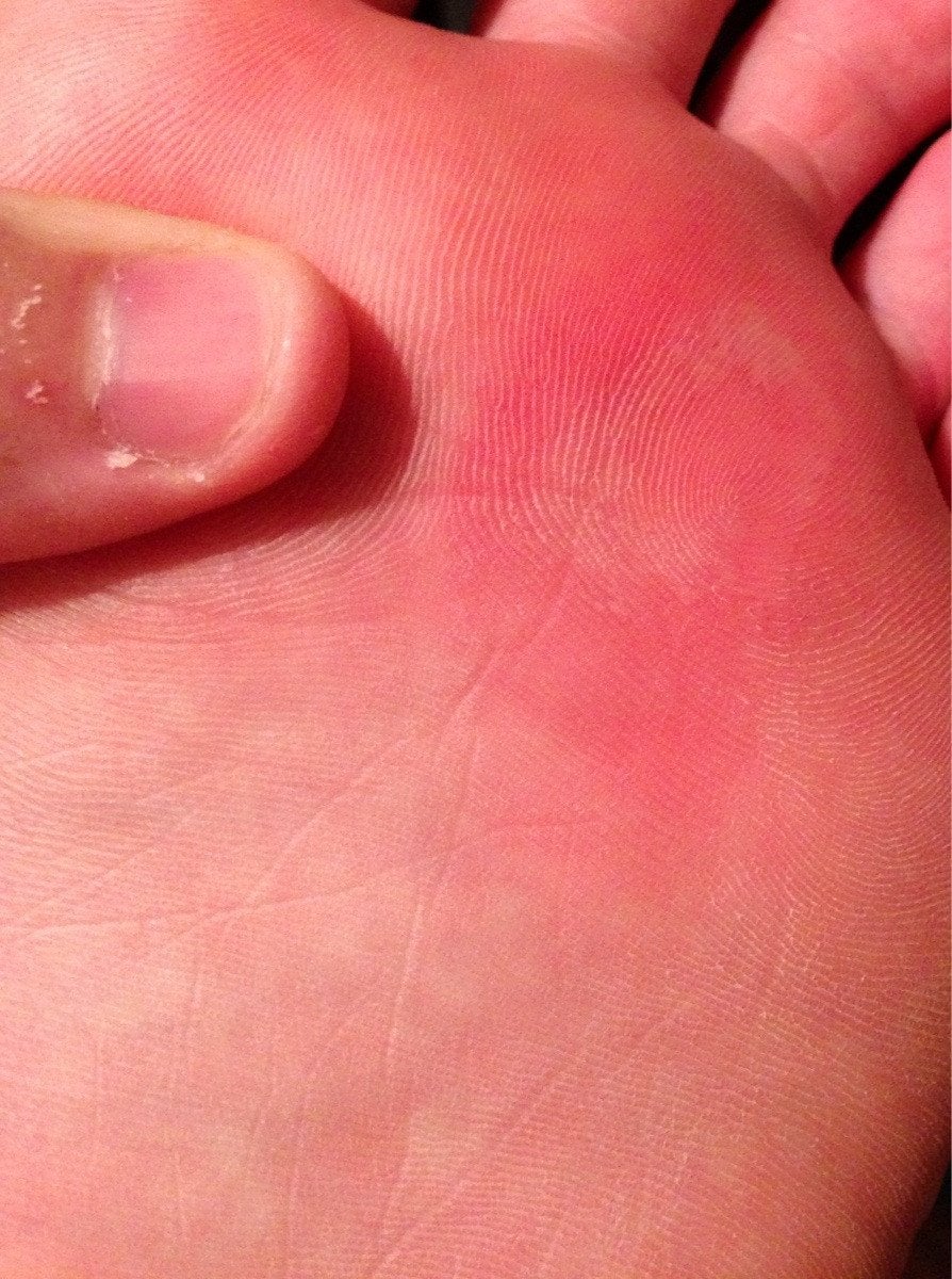 A spot on my foot is KILLING me! I started jogging ...
