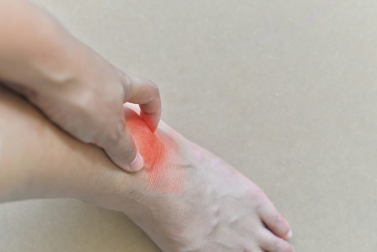 An Overview About Gout In The Knee