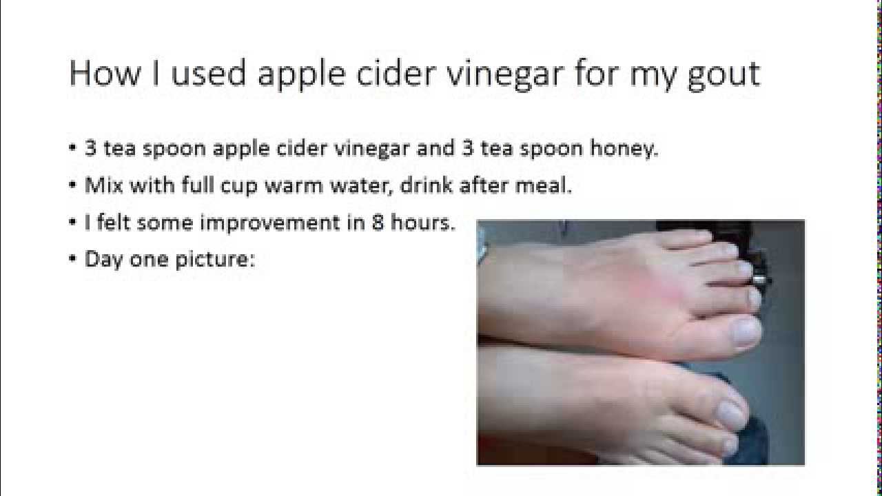 Apple cider vinegar for my Gout Treatment