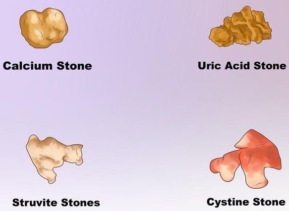 Are Kidney Stones Like Gout