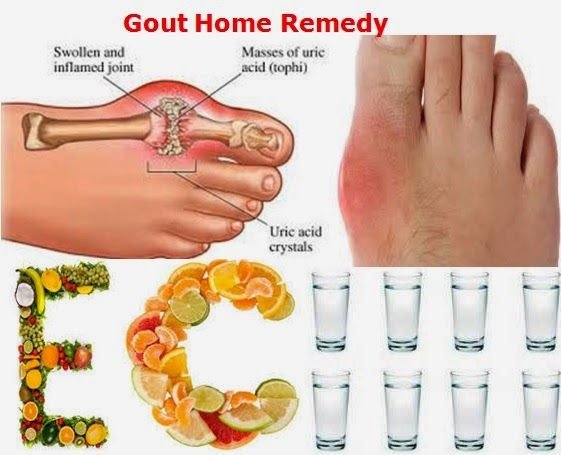 are the symptoms of gout for chronic kidney disease ckd patients gout