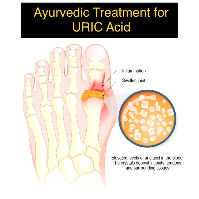 Ayurvedic Treatment for Uric Acid