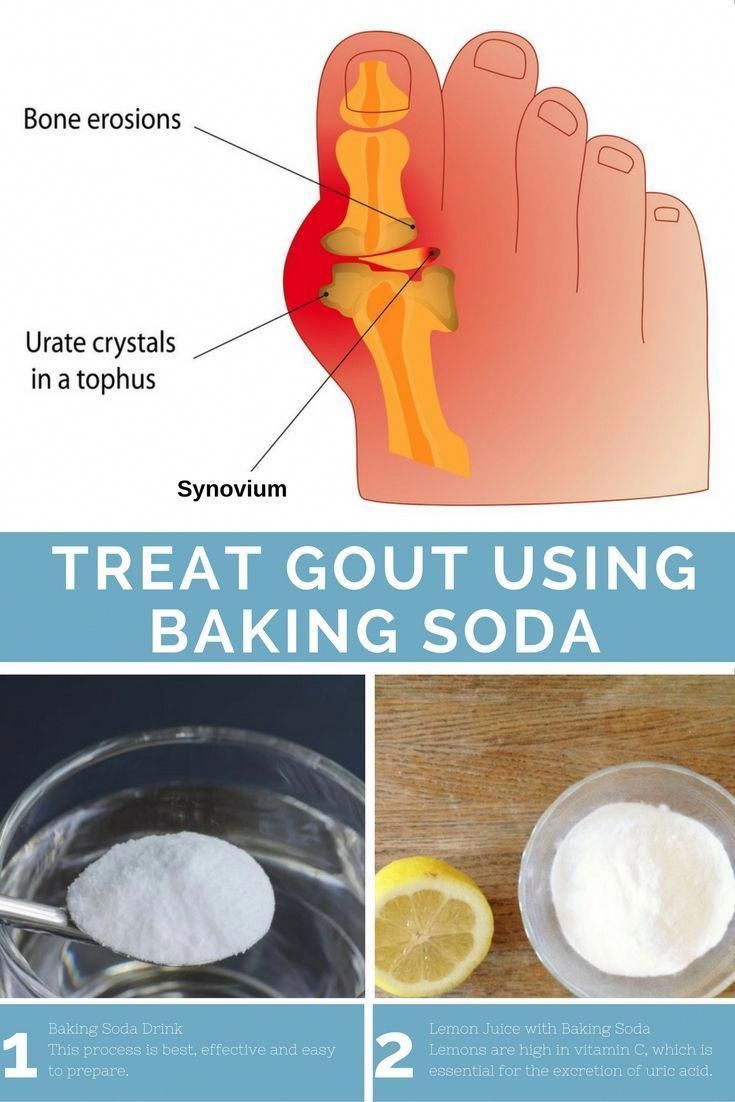 Baking Soda for Gout #arthritisrelief # ...