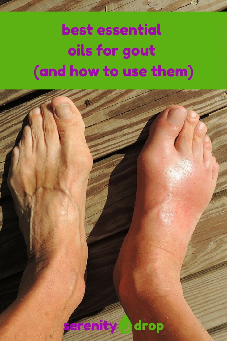 Best Essential Oils for Gout and How to Use Them in 2020 ...