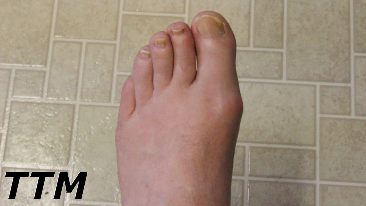 Big Toe Pain From Nerves or Gout?~Lower Back and Leg Pain~Nerve Pain in ...