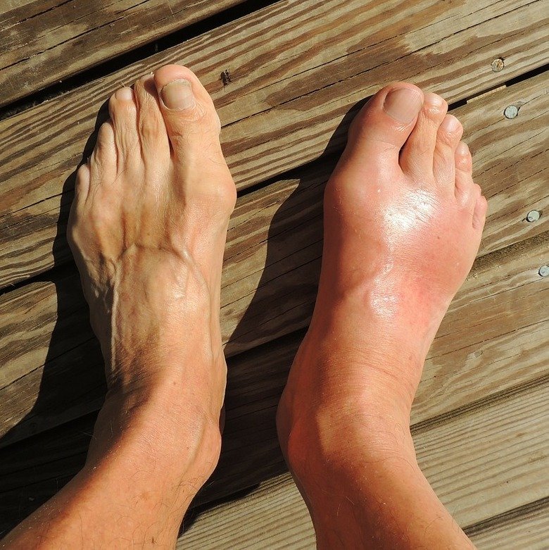 BREAKING! Gout And Arthritis: Report Warns That Global ...