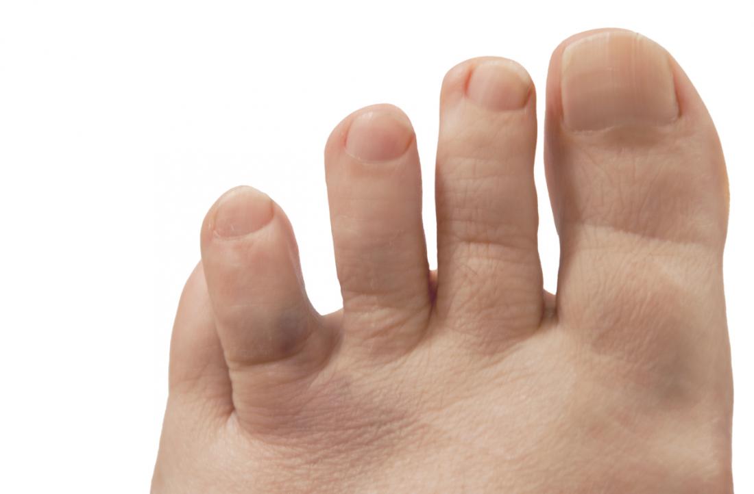 Broken toe: Symptoms, pictures, and treatment