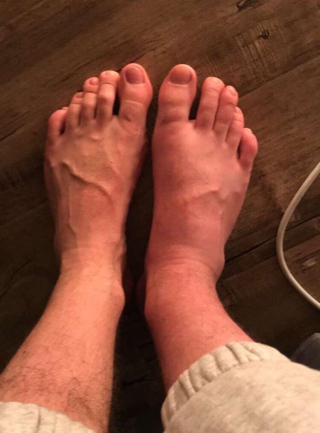 Brothers most recent flare up : gout
