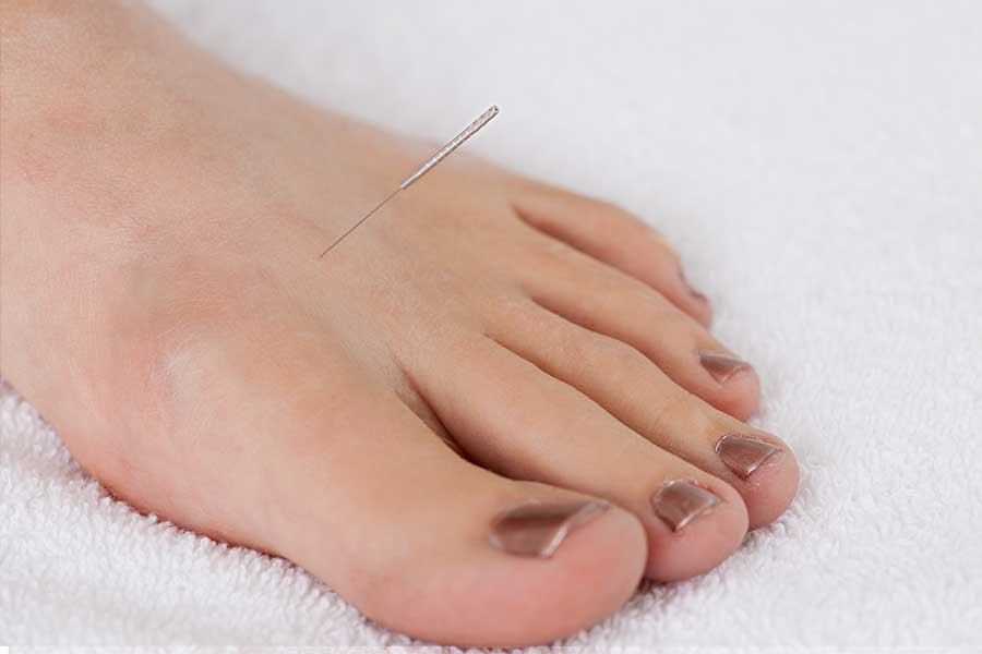 Can Acupuncture Treatment Help More Young Singaporeans ...