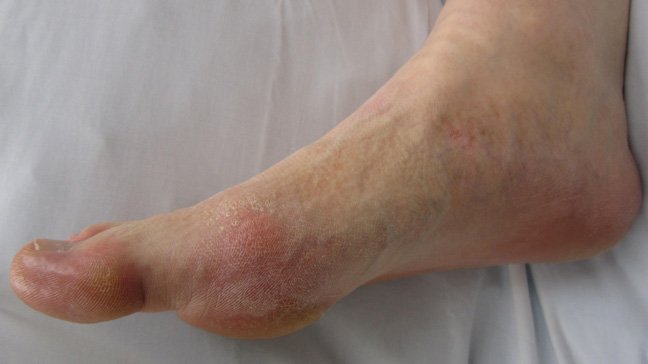 Can Gout Affect The Ball Of Your Foot