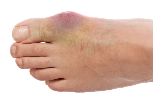 Can Gout Be Cured Or You Must Live With This Disease?