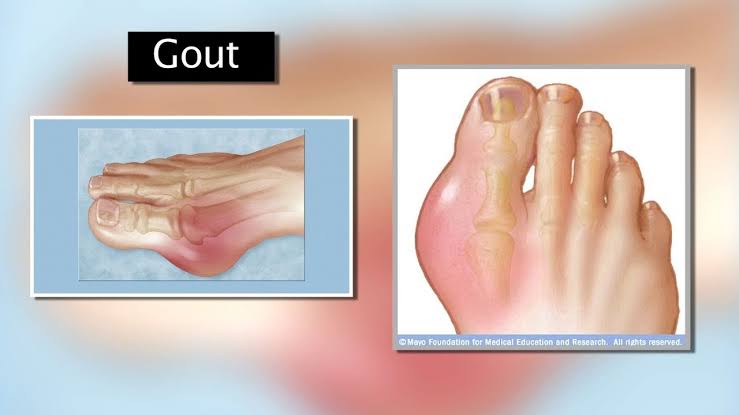 Causes of gout in big toe: How to identify and treatment