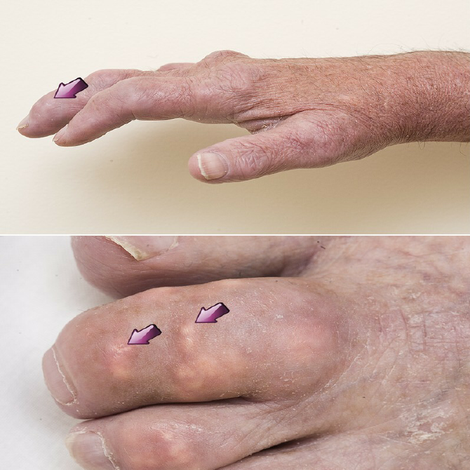 Chronic tophaceous gout involving fingers and toes