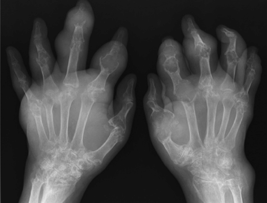 Clinical features of chronic gout. Plain radiograph showing asymmetric ...