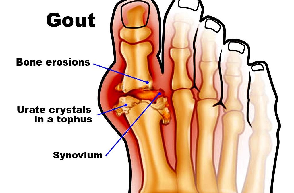 Dietary advice for gout