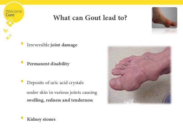 Disable Gout before It Disables You with Homeopathy!