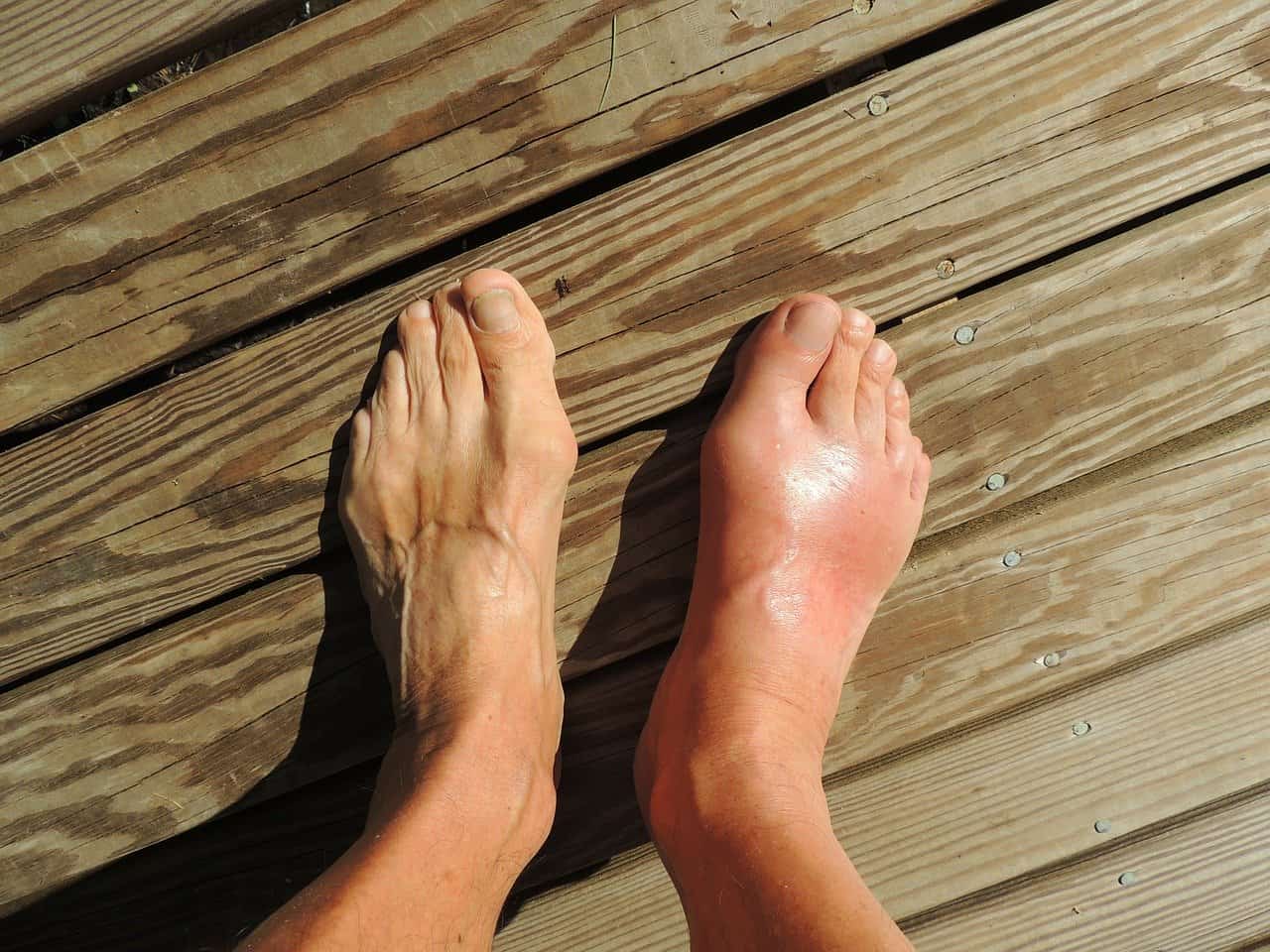Do You Have MS, Gout or RA and Foot Pain?
