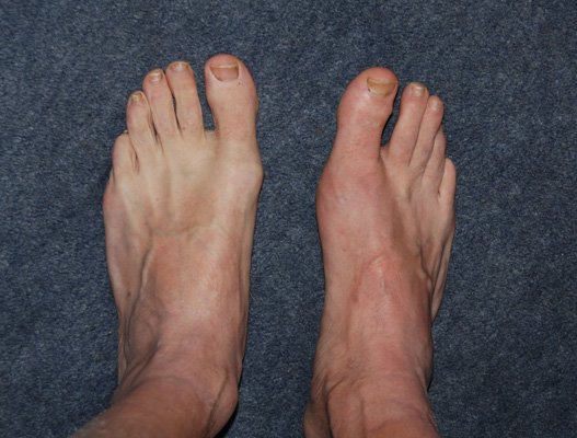 Do You Know The Foods That Cause Gout?