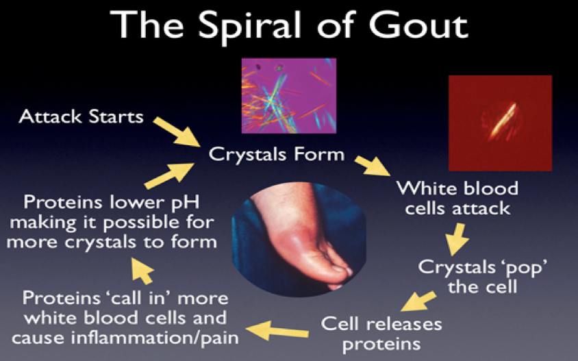 Does Diet Soda Cause Gout ~ bybluedesign