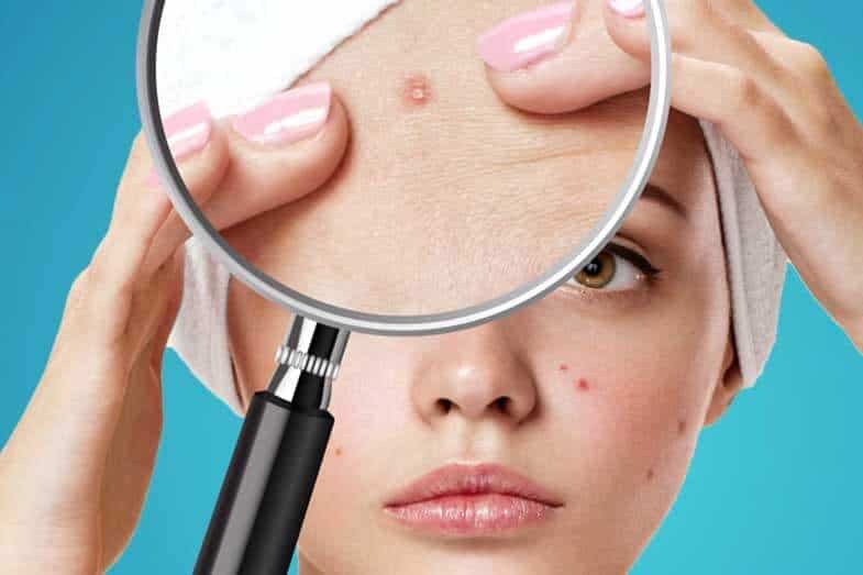Does Rhinitis Go Away : Does Acne Go Away Naturally? Plus ...