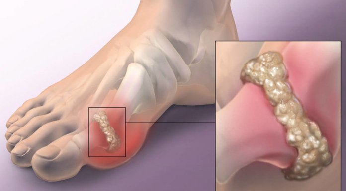 Easy Ways To Remove Uric Acid From Your Joints