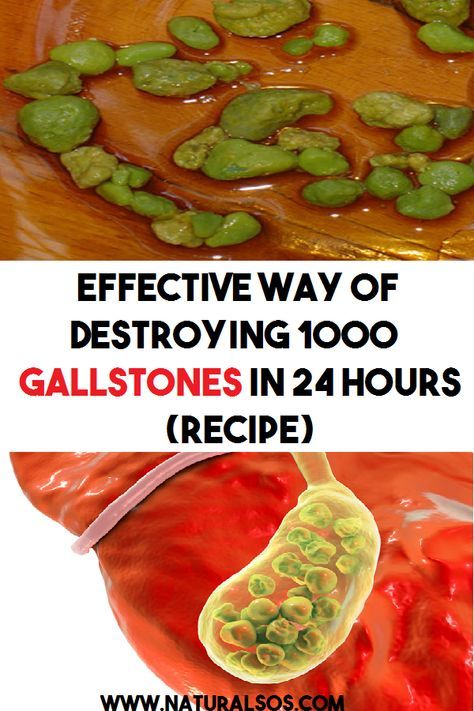 Effective Way of Destroying 1000 Gallstones In 24 Hours ...