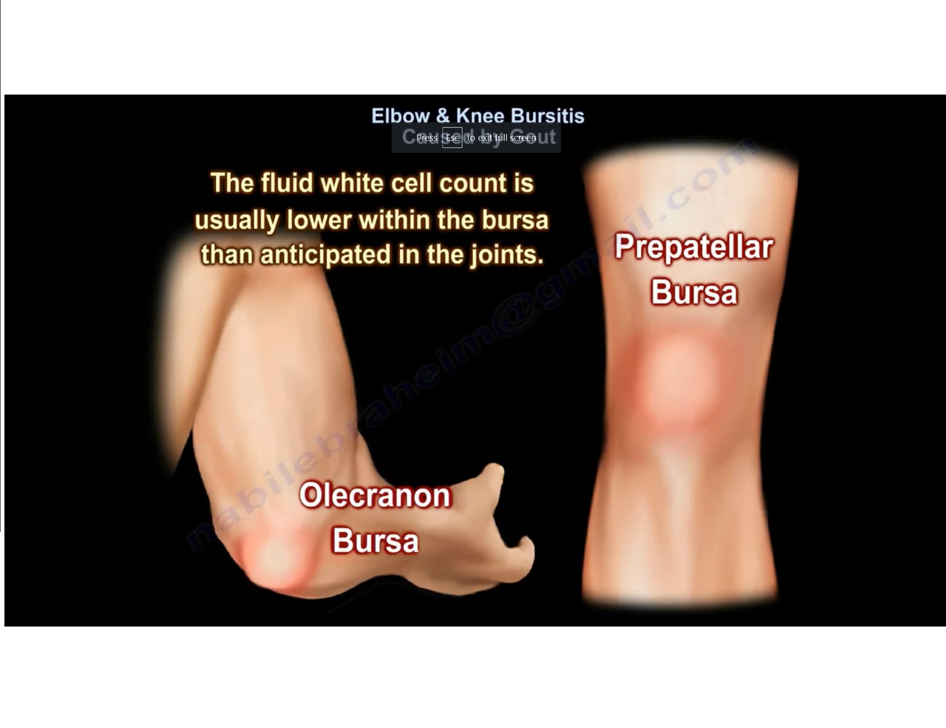 Elbow and Knee Bursitis caused by Gout ...