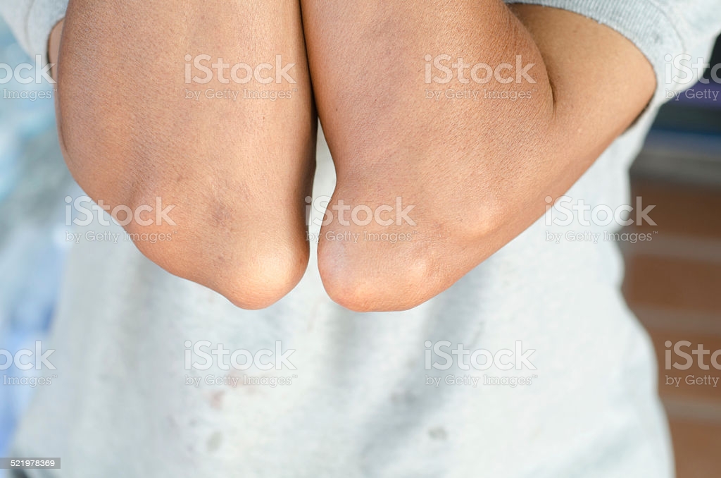 Elbow Of Patients With Gout Stock Photo