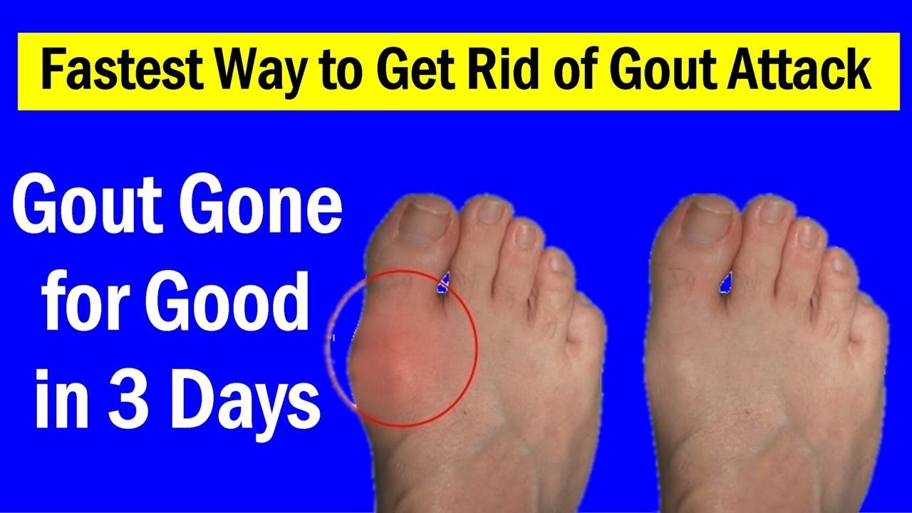 Fastest Way to Get Rid of Gout Attack