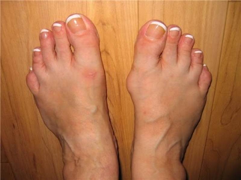 Feet gout pictures