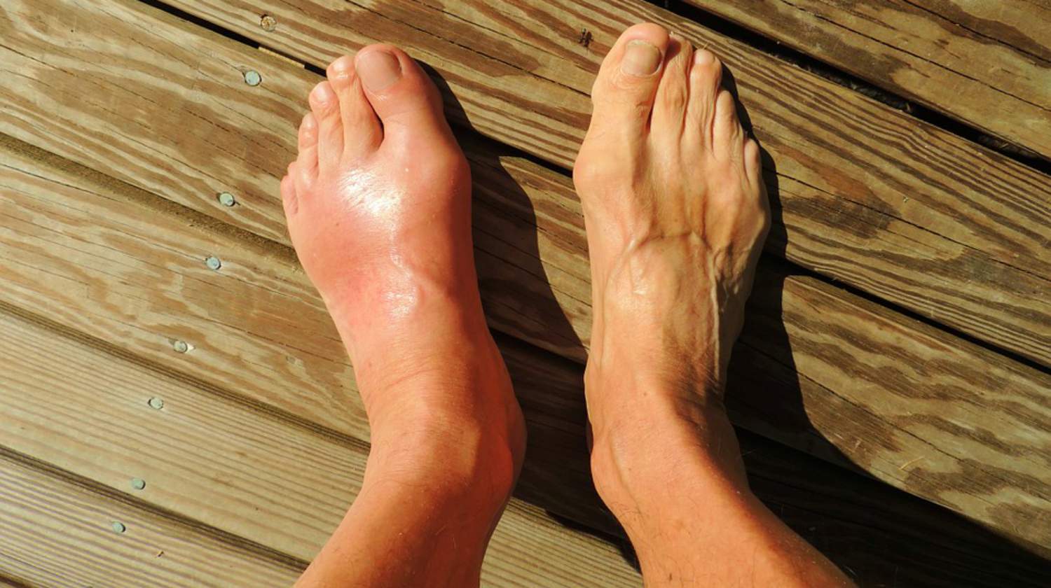 Foot Pain Gout