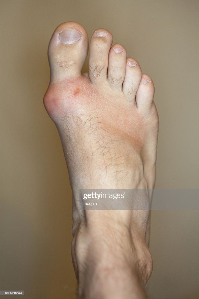 Foot With Gout And Bunion High