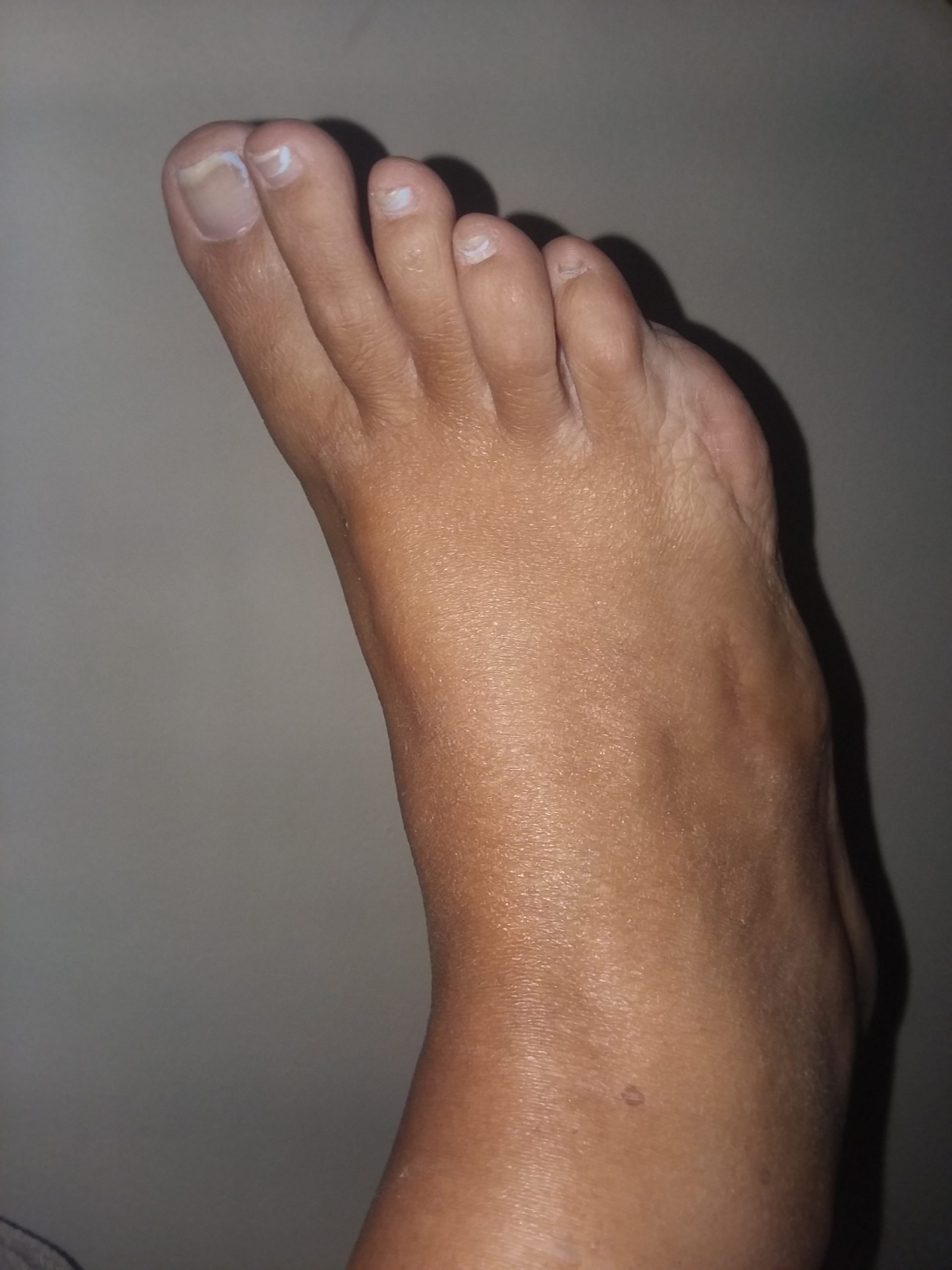 For over 10 years severe pain. Chronic gout in feet, knee ...