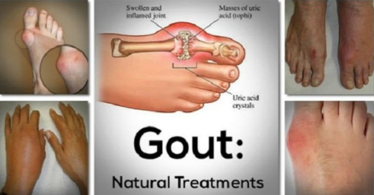 Get Rid of The Gout In No Time With This Effective Natural Treatment