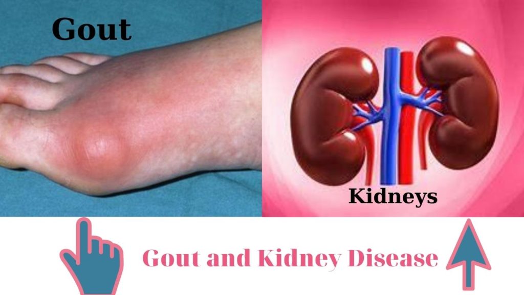 Gout and Kidney Disease