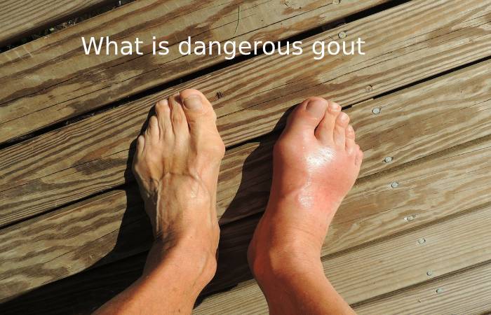 Gout Arthritis Symptoms Diagnosis And Treatment In Men