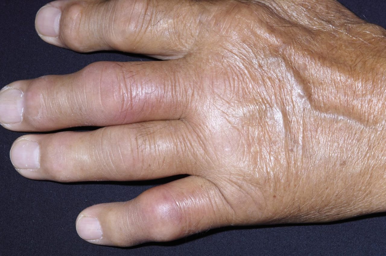 Gout Associated With Psoriatic Arthritis, Psoriasis in Adults ...